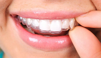 Invisalign® clear aligners